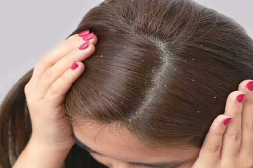 anti dandruff treatment